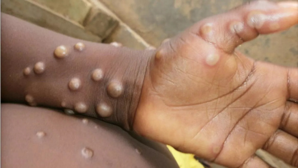 Variole du singe au Sénégal : 25 cas contacts recensés