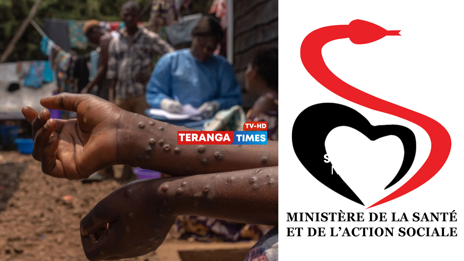 Mpox : le patient guéri, plus aucun cas au Sénégal