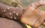 Variole du singe au Sénégal : 25 cas contacts recensés